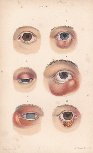 Illustrations of Some of the Principal Diseases of the Eye, with a Brief Account of their Symptoms, Pathology, and Treatment.