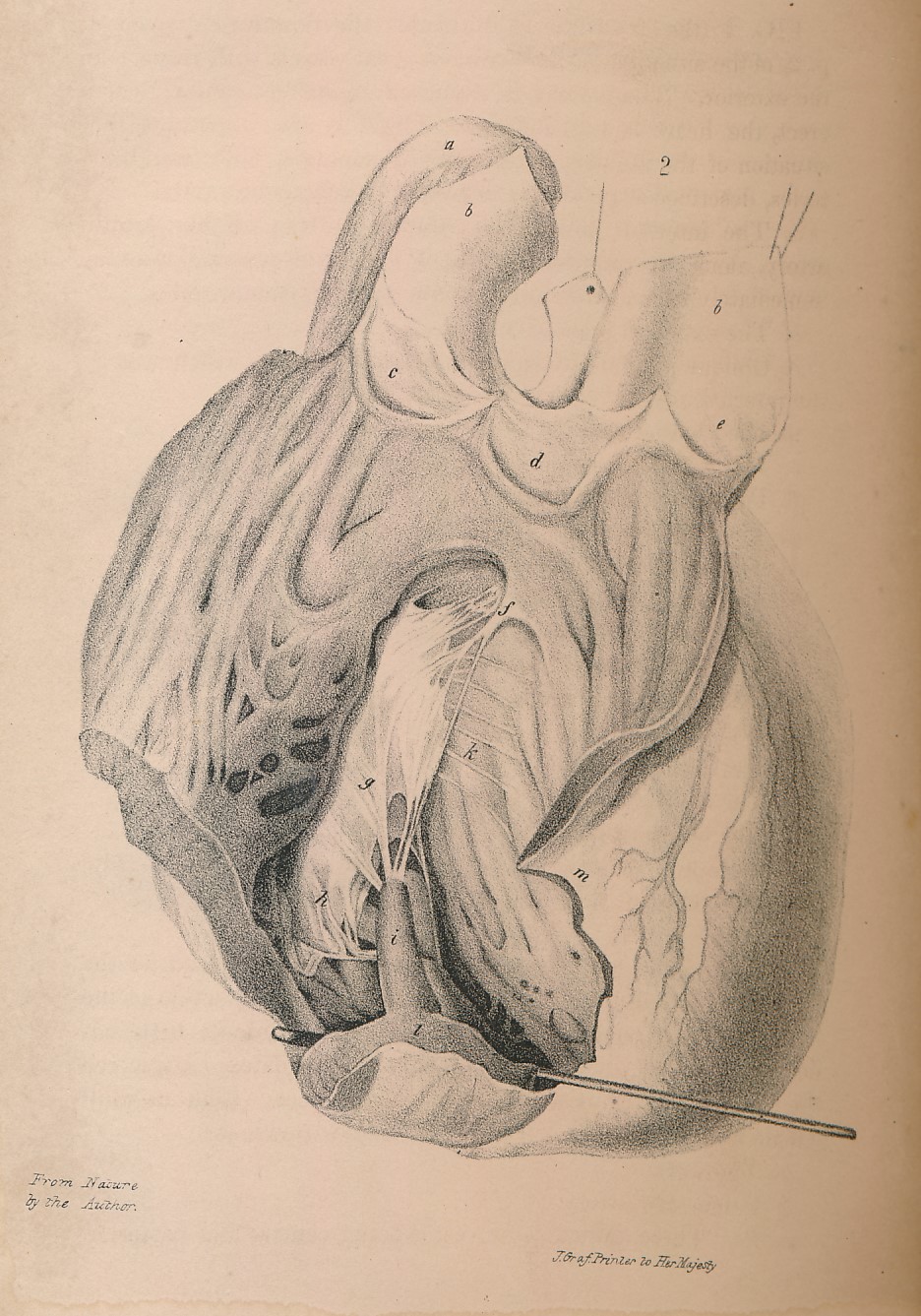 A Treatise on the Diseases of the Heart and Great Vessels, and on the Affections Which May be Mistaken for Them: Comprising the Author's View of the Physiology of the Heart's Action and Sounds, as Demonstrated by His Experiments on the Motions and Sounds