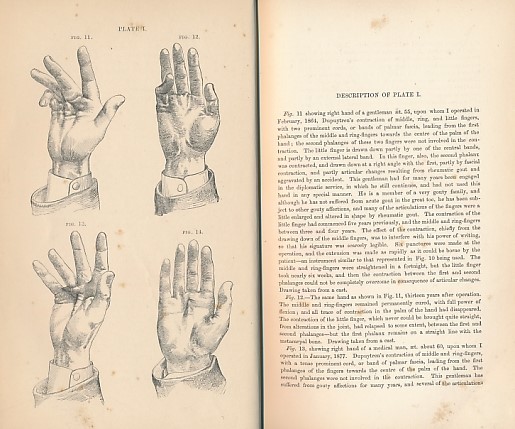 Observations on Contraction of the Fingers [Dupuytren's Contraction] and Its Successful Treatment by Subcutaneous Divisions of the Palmar Fascia, and Immediate Extension. Also on the Obliteration of Depressed Cicatrices....