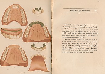 Crown, Bar, and Bridge-Work: New Methiods of Permanently Adjusting Artificial Teeth Without Plates. Authors inscription.