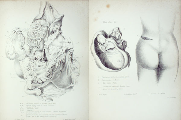A Case of Carcinomatous Stricture of the Rectum; in Which the Descending Colon was Opened in the Loin.